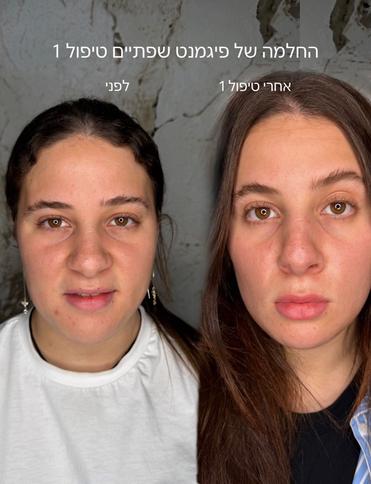 שפתיים לפני ואחרי טיפול אחד — בלי הזרקה
